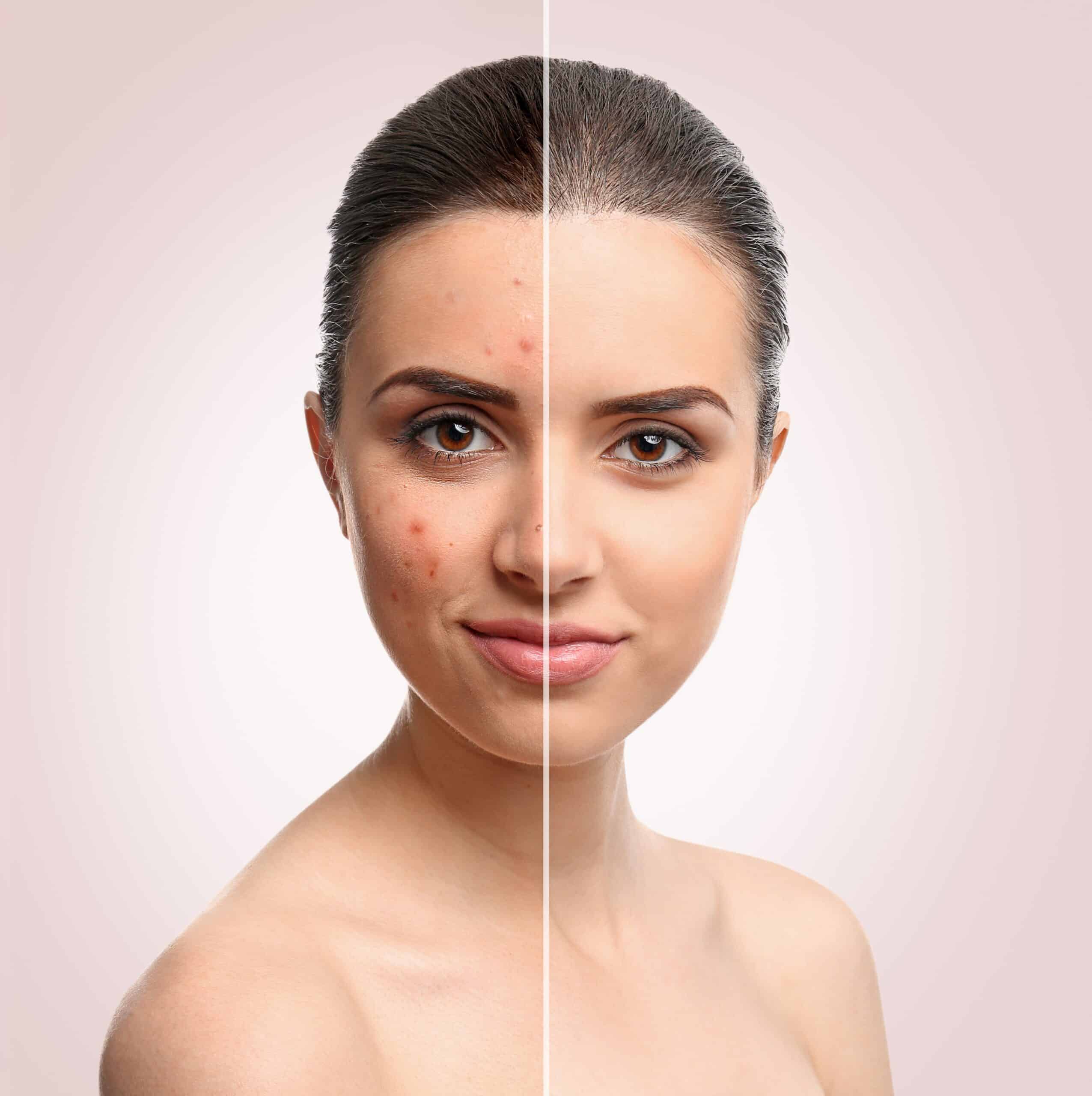 Wirksamkeit von Lactoferrin, Vitamin E und Zink zur Aknebehandlung