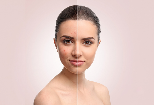 Akne gezielt von innen behandeln mit Lactoferrin, Vitamin E und Zink