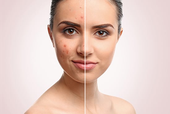 Lactoferrin mit Vitamin E und Zink als orale Therapie bei leichter bis mittelschwerer Akne vulgaris